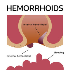 anal, anatomy, anus, bleeding, blood, cartoon, digestion, external, hemorrhoid, illustration, infographic, internal, rectal, swelling, vector