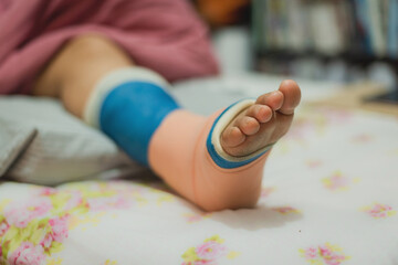 Obraz na płótnie Canvas Close-up Of A Women's Broken Leg .