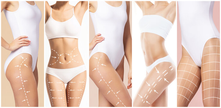 Female body with the drawing arrows on it. Fat lose, liposuction and cellulite removal concept.