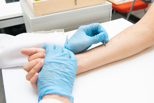 doctor doing allergy test to her patient, skin prick test at her patient in medical office