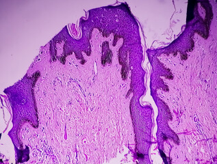 Histological biopsy of Scrotal wall under microscopy showing Calcinosis cutis. Scrotal calcinosis. Calcinosis cutis of scrotum