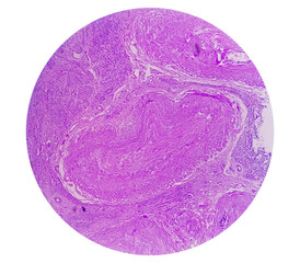 Histological examination of uterus biopsy suggestive uterine prolapse. Chronic cervicitis with prolapse.
