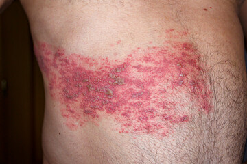 Skin lesion symptom in Shingles or Herpes zoster in human. Shingles or Herpes zoster is aviral disease caused by varicella zoster virus charatrized by a painful skin rash with blisters on the body.
