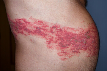 Skin lesion symptom in Shingles or Herpes zoster in human. Shingles or Herpes zoster is aviral disease caused by varicella zoster virus charatrized by a painful skin rash with blisters on the body.