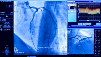 projection of veins on the screen in heart surgery, transcatheter aortic valve implantation,...