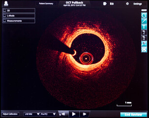 intravascular optical coherence tomography oct image angiography catheter lab atherosclerosis....