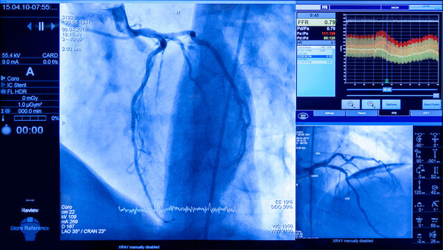 projection of veins on the screen in heart surgery, transcatheter aortic valve implantation, Preparation of the Volcano Refinity IVUS Catheter, intravenous imaging
