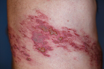 Skin lesion symptom in Shingles or Herpes zoster in human. Shingles or Herpes zoster is aviral disease caused by varicella zoster virus charatrized by a painful skin rash with blisters on the body.