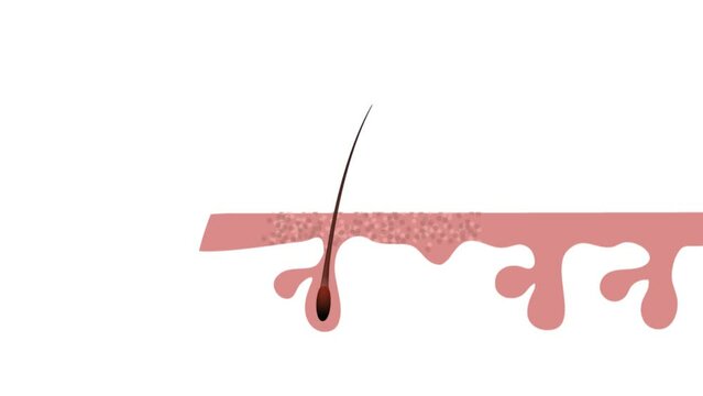 Shrinking of hair follicles result in hair loss, baldness, alopecia. The diagram represents this decrease of follicle size contributing to hair fall. 