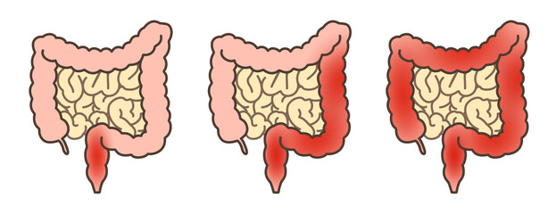 潰瘍性大腸炎直腸型 - obrazy, fototapety, plakaty