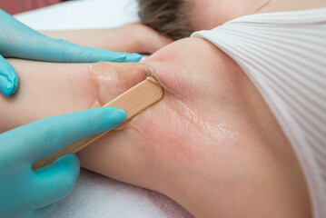 Depilation and epilation of the female armpit with liquid sugar paste. The beautician's hand applies wax paste to the armpit.