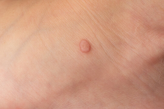 Common wart Verruca vulgaris on the skin of a child.