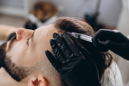 An attractive man receives mesotherapy injections to treat hair loss at the clinic. Injections into the skin and scalp