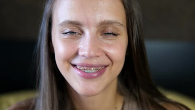 Beautiful smiling girl with brackets for teeth. Smiling woman. Female smile with dental braces close up. Braces Mouth