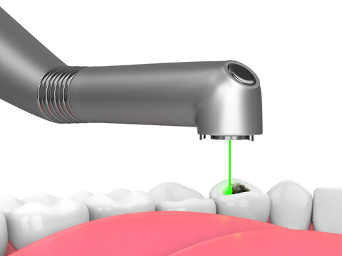 3d render of removing tooth decay with dental laser