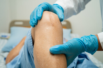 Asian senior or elderly old lady woman patient show her scars surgical total knee joint replacement...