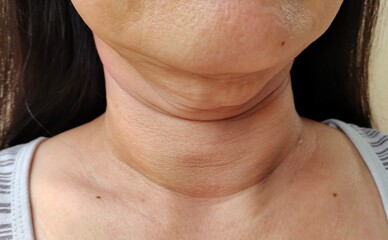 close up of a woman showing the flabbiness adipose sagging skin under the neck, wrinkles and flabby skin, problem cellulite and rough skin under the chin of the woman, concept health care.