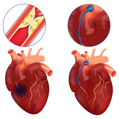 Coronary bypass. Surgery to restore blood flow in the arteries of the heart. Vector illustration. - obrazy, fototapety, plakaty