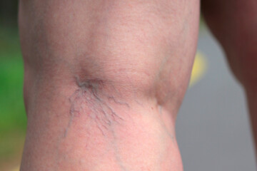 Naklejka premium Painful varicose veins (spider veins, varices) on a severely affected leg. Ageing, old age disease, aesthetic problem concept.