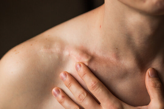 Close-up of man's collarbone injury. Black background. Injured athlete after successful fractured clavicle bone surgery.