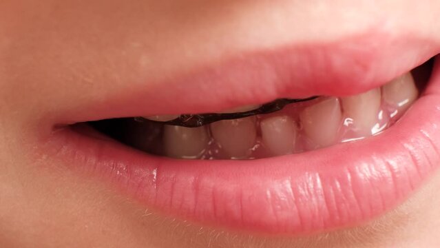 A close-up of a child's smile. Teeth with a replacement orthodontic plate to align the teeth
