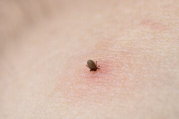 Sucking tick Macro photo on human skin. Ixodes ricinus. Bloated parasite bitten into pink irritated epidermis. Small red drops. Dangerous insect mite. Encephalitis, Lyme disease infection