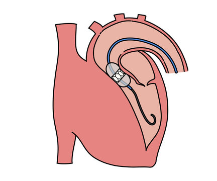 経カテーテル的大動脈弁留置術