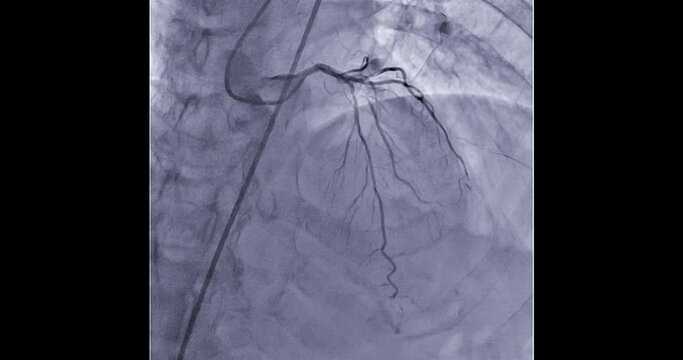 Coronary angiogram of coronary artery during cardiac catheterization  in cardiac catheterization laboratory.