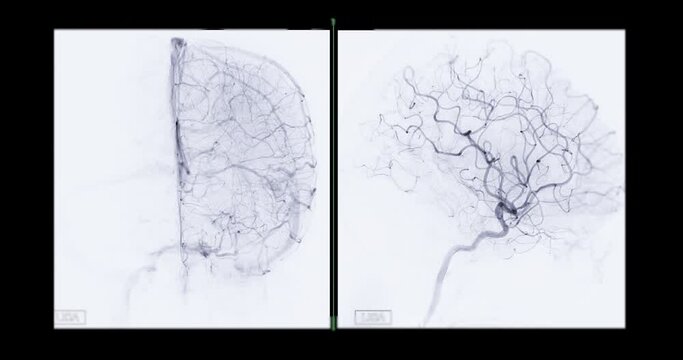 Cerebral angiogram  for diagnosis abnormalities such as cerebral artery aneurysms and cerebral artery disease such as atherosclerosis (plaque).