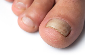 Close up image of a finger with nail fungus infection