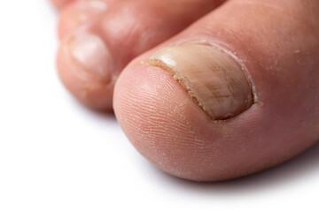 Close up image of a finger with nail fungus infection