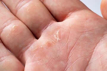 Hand with blister and callus close up