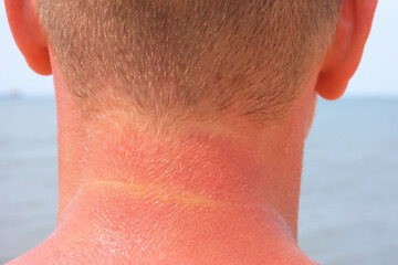 The man received sunburn on the seashore. The skin peels off. Protection of the skin from the sun.