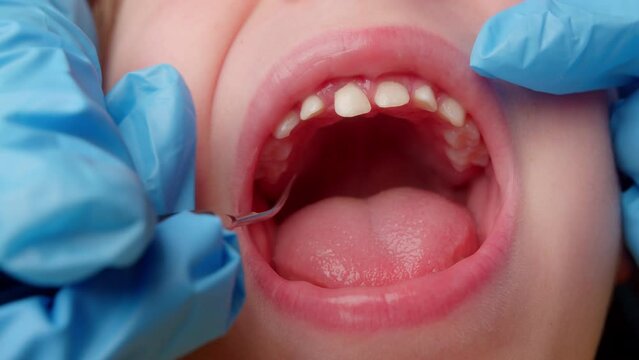 Open mouth child close-up at dentist, close up hands dentist who makes brushing teeth ultrasound. Female professional dentist at work. Dental checkup concept. Dentist work with children.