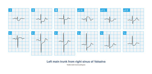 An 11 year old boy had sudden chest pain after playing football, extensive ST segment depression on ECG, and coronary angiography confirmed that the LM trunk originated from the right coronary sinus. 