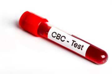 CBC test for abnormalities in red blood cells, Blood samples to be analyzed in the laboratory