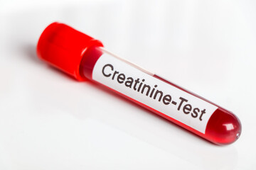 Creatinine test from blood , Blood samples to be analyzed