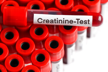 Creatinine test from blood , Blood samples to be analyzed