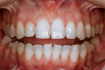 Teeth close-up. After correction by an orthodontist. White, even, beautiful teeth.