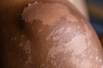 Fototapeta premium Male sunburned skin close up