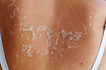 Fototapeta premium Back close-up with tank top straps, with sunburn, shabby flaky skin, reminiscent of outline of map of country Ukraine
