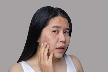 Asian adult woman's face has freckles, large pores, blackhead pimples and scars problem from not...