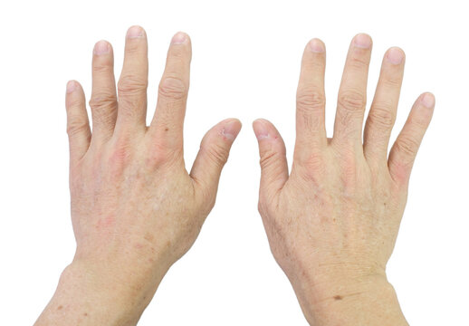 Small brown spots on the skin of the senior man's hands. Fingers and nails with dry skin, torn and flaking off, cracked skin on cuticles, Isolated on white background.