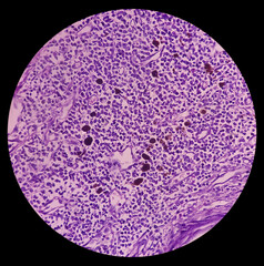 Skin biopsy, Scalp carcinoma, pigmented basal cell carcinoma, the most common type of sun induced skin cancer.