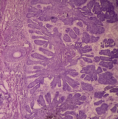Skin biopsy, Scalp carcinoma, pigmented basal cell carcinoma, the most common type of sun induced...