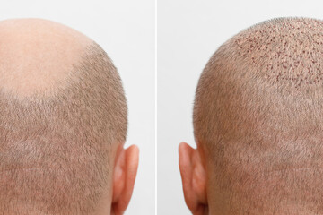 The head of a balding man before and after hair transplant surgery. A man losing his hair has...