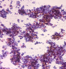 Abnormal squamous epithelial cells view in microscopy.HPV criteria for pap smear slide cytology. Medical concept.