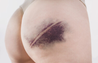 Closeup of a bruise on a woman's thigh. Large hematoma. Female buttocks with a bruise after an...