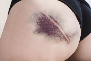Closeup of a bruise on a woman's thigh. Large hematoma. Female buttocks with a bruise after an injury close up