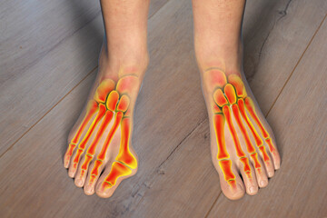 Toe deformation, also known as hallux valgus, or bunion